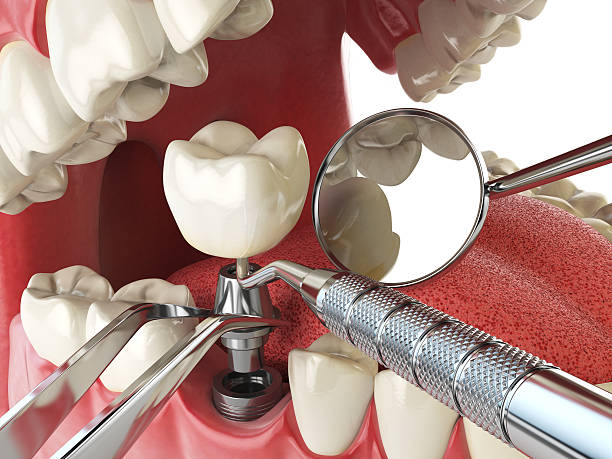 Best Broken or Chipped Tooth Repair in Lake Winnebago, MO